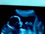 Fertilidad después aborto