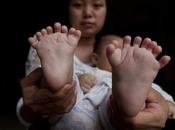 Bebé nació dedos China