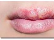 Herpes Labial