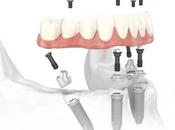 Prótesis dentales permanentes: Pros contras