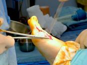 Eliminación Juanetes (Bunionectomía): Preparación para cirugía recuperación post operatoria