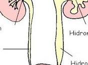 Hidronefrosis embarazo