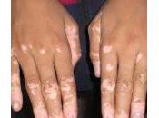 Tipos vitiligo.Opción tratamiento