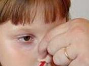Hemorragias nariz, causas tratamiento &#8211;