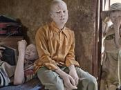 ‘Albino’, Palacios: Libro exposición denuncia situación albinos África