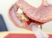 Nueva opción cirugía podría ayudarle perder peso vencer diabetes tipo