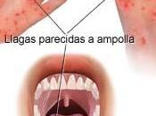 Enfermedad Manos Boca