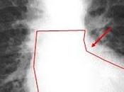 Signos radiográficos clásicos cardiopatías congénitas