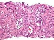 Descifran genoma siete tipos cáncer próstata