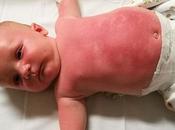 producto “Peppa Pig” provocó serias quemaduras bebé tres meses