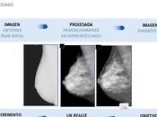 Mamografia digital mamografia analogica
