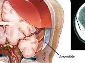 Hematoma subdural crónico pacientes ancianos.