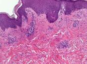 ¿Qué pitiriasis rosea?