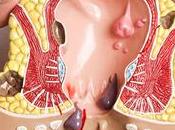 Cáncer