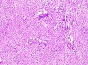 Granuloma piógeno