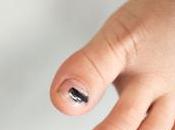 Hematoma subungueal