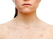 Tratamiento anticonceptivo oral para acné