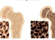 debe hacer para detectar padece Osteoporosis #Medicina #Salud