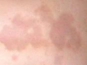 Morfea escleroderma