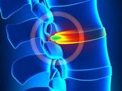 ¿Qué hernia disco lumbar?