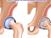 Osteoartritis cadera