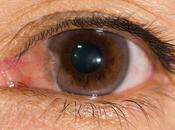 Tratamiento para pinguecula pterigión