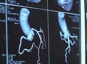 Tratamiento fibrilación atrial: medicamentos, procedimientos cambios estilo vida