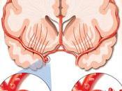 Reducción gravedad accidente cerebrovascular ejercicio regular