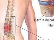 Hernia disco tratamiento quiropráctico