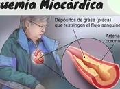 Isquemia Miocárdica Cardiopatía Isquémica