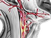 Enfermedad arteria carótida: síntomas tratamientos estenosis