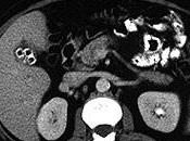 Colecistitis