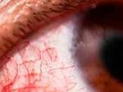 Epidemia Conjuntivitis hemorrágica rompe récord infectados Ciego Ávila