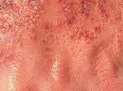 Dermatitis