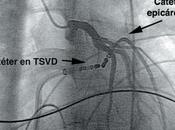 Tratamiento Fibrilación Auricular Ablación Catéter