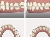 experiencia Invisalign