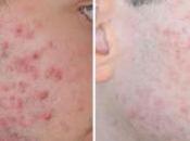 Como Quitar Acne Hormonas