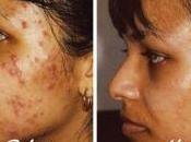 Como Eliminar Acne Severo Naturalmente