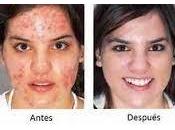 Como Sacar Acne Dela Cara Para Siempre