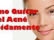 Mejores Metodos Caseros Para Eliminar Acne