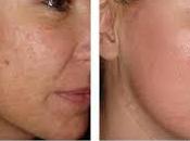 Remedios Caseros Para Eliminar Acne Siempre