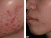 Tecnicas Simples Para Eliminar Acne Rapidamente