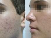 Como Eliminar Acne Naturalmente: Errores Evitar