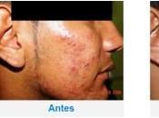 Como Limpiar Acne Dela Cara Naturalmente