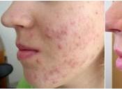 Como Eliminar Acne Cara?