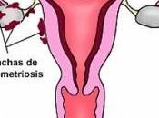 endometriosis