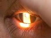 Crónico irreversible, glaucoma segunda causa ceguera mundo