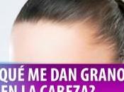 Como Quitar Barros Cabeza?