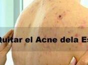 Como Quitar Acne Dela Espalda?