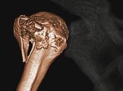 Caso clínico Fractura hombro tomografía imagen
